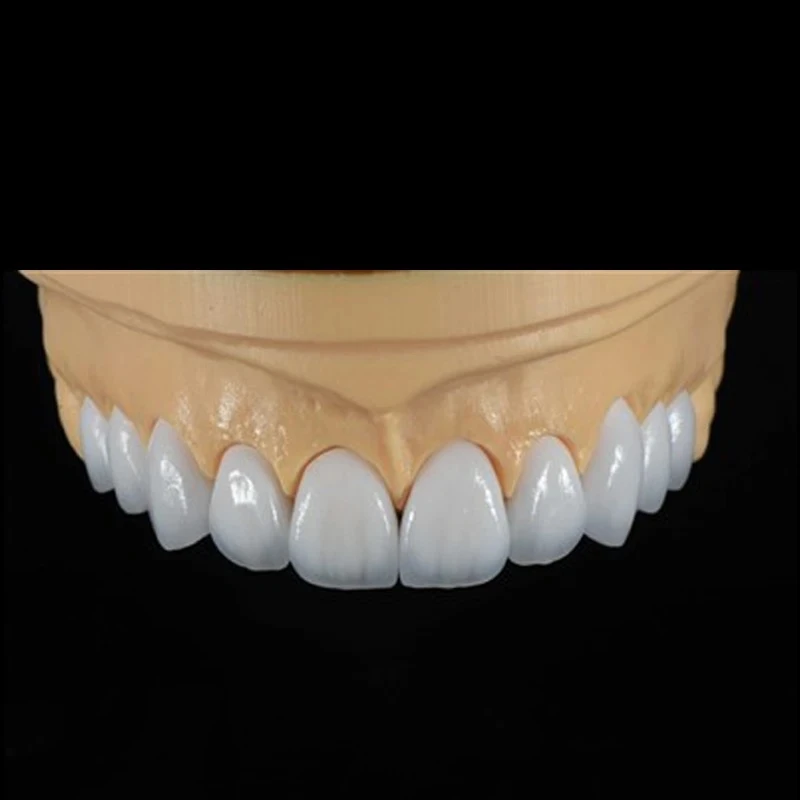 E-max Veneer E-max Veneer