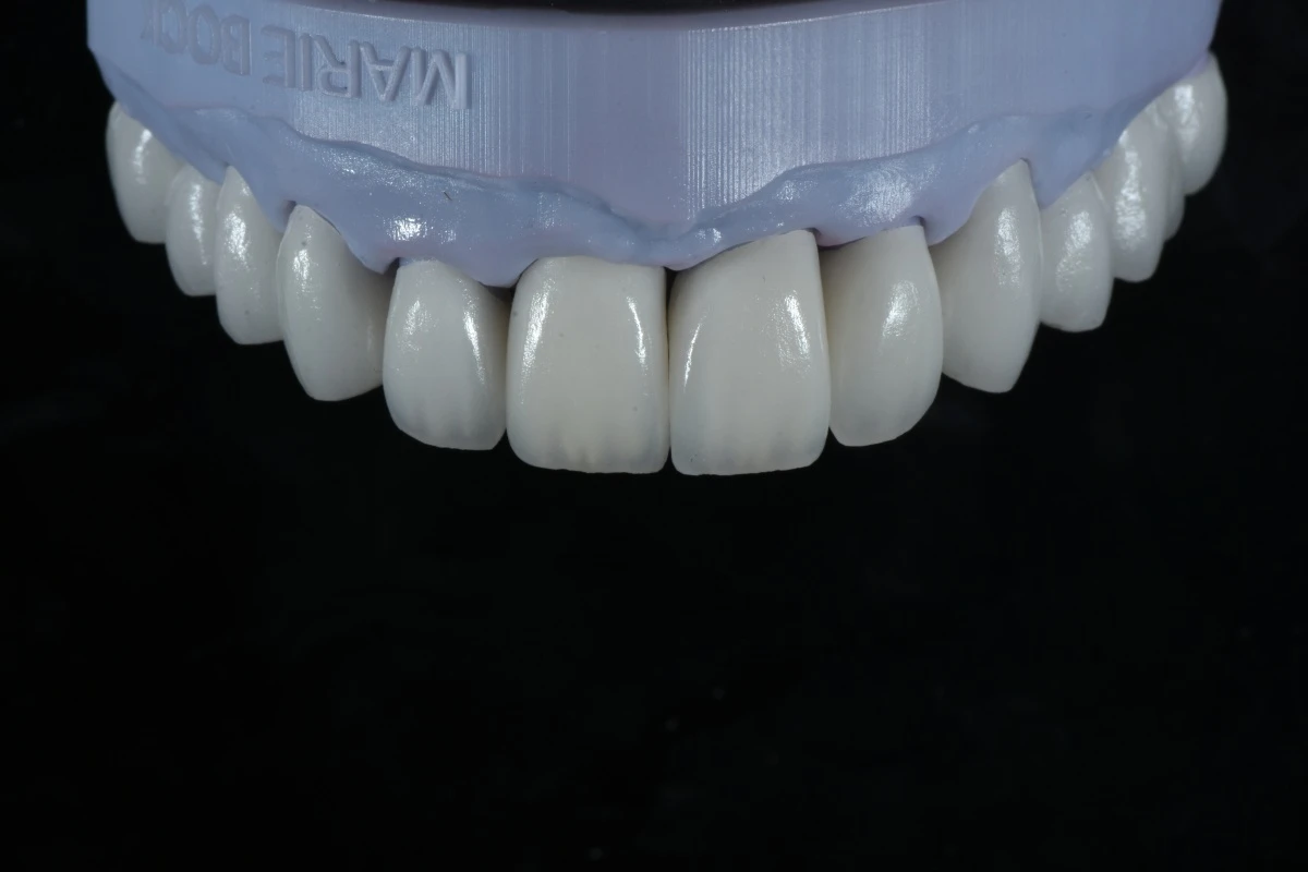 E.max Layering Veneers E.max Layering Veneers