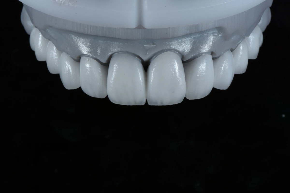 Digitally Designed E.max Layering Veneers Digitally Designed E.max Layering Veneers