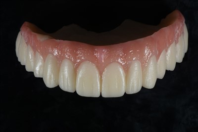 아크릴 수지 임시 크라운